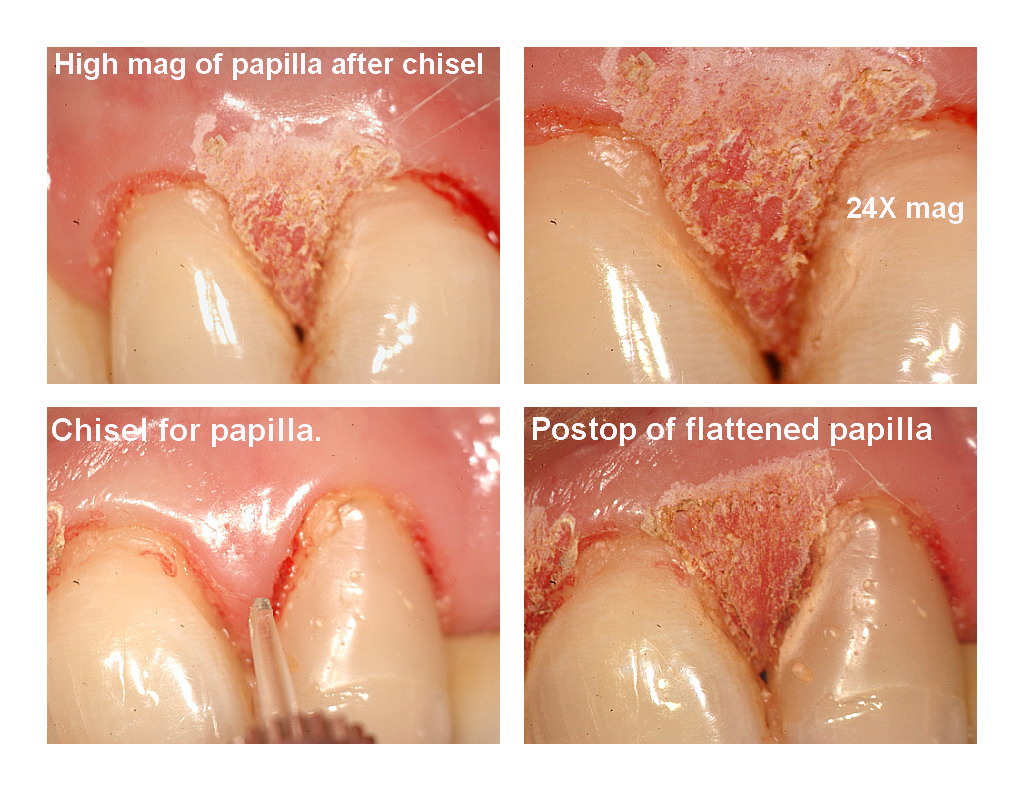 Veneers and recontouring pg4.jpg